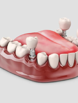 zirconia crown material | csd laboratory