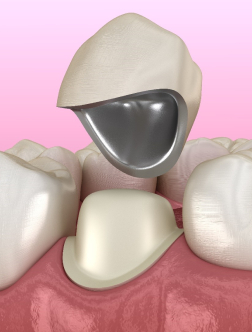 metal ceramic crown bridges | csd laboratory