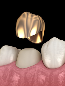 metal crown bridges | csd laboratory