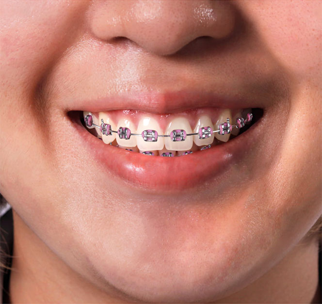 Teeth Braces | csd laboratory