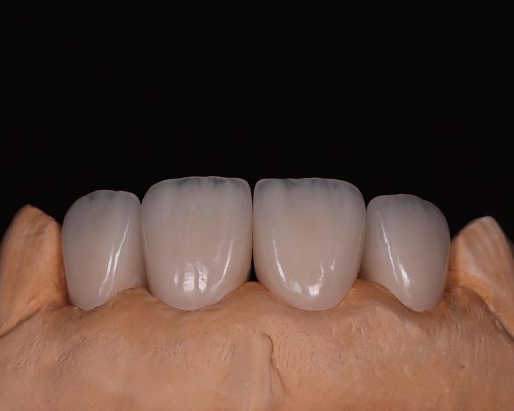 precision-crafted zirconia crowns bridges at CornerStone Dental Laboratory Bangalore